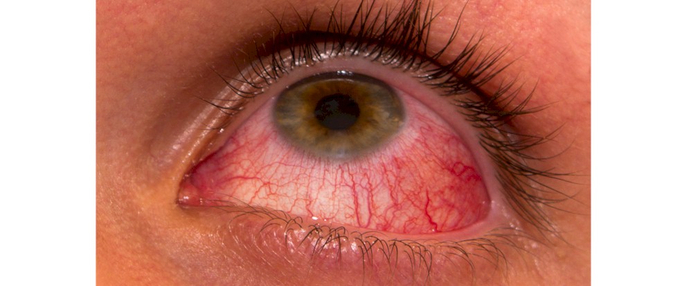 Ceratite Microbiana Doenca Ocular Que Pode Levar A Cegueira